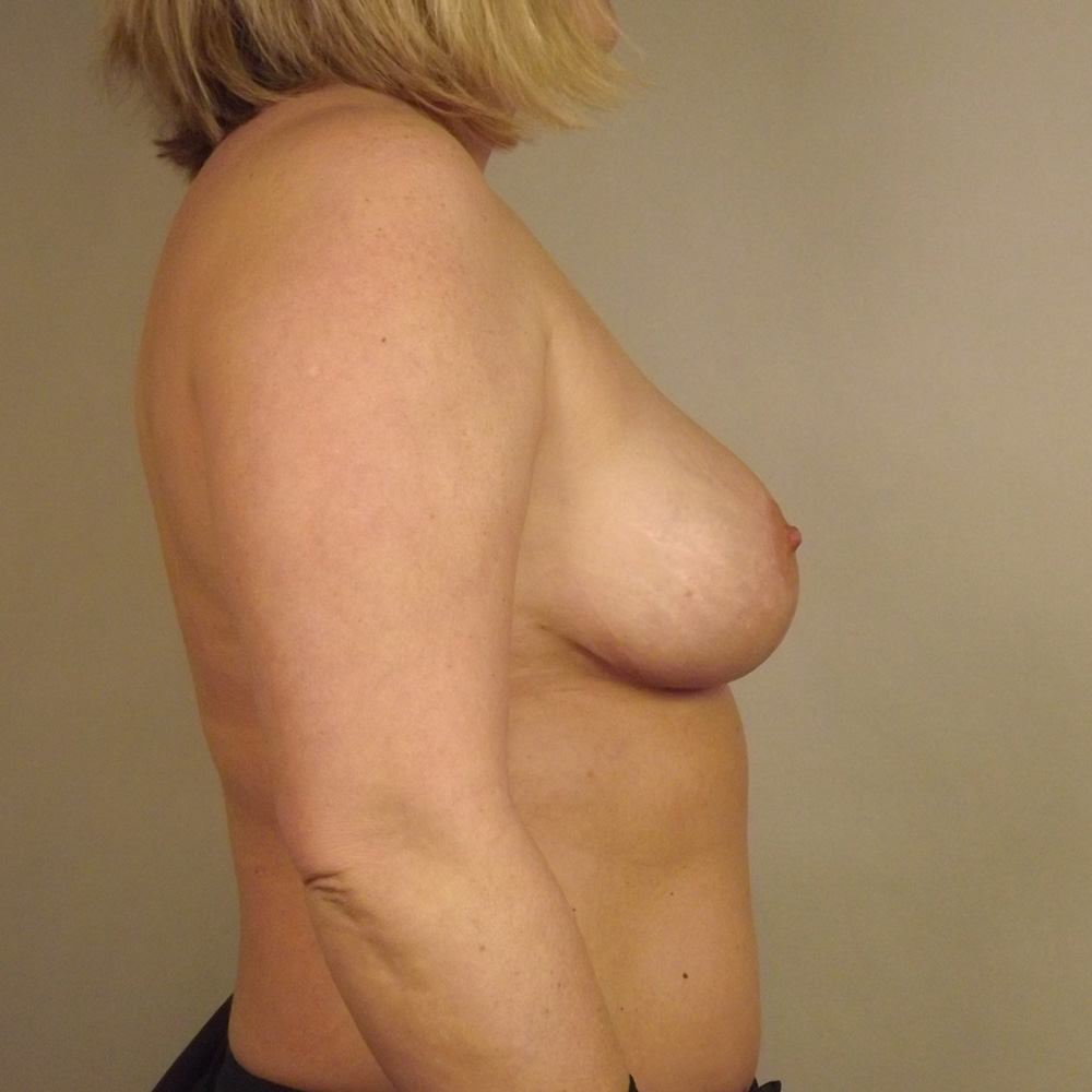 Case--2538 | After Bilateral Reduction Mammaplasty (Breast Reduction) 2