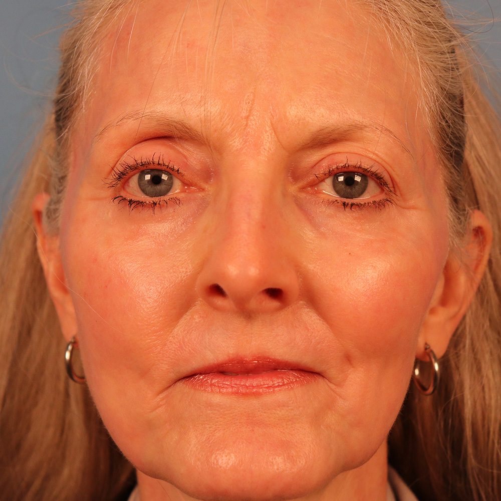 Case--1130 | After Sciton Laser