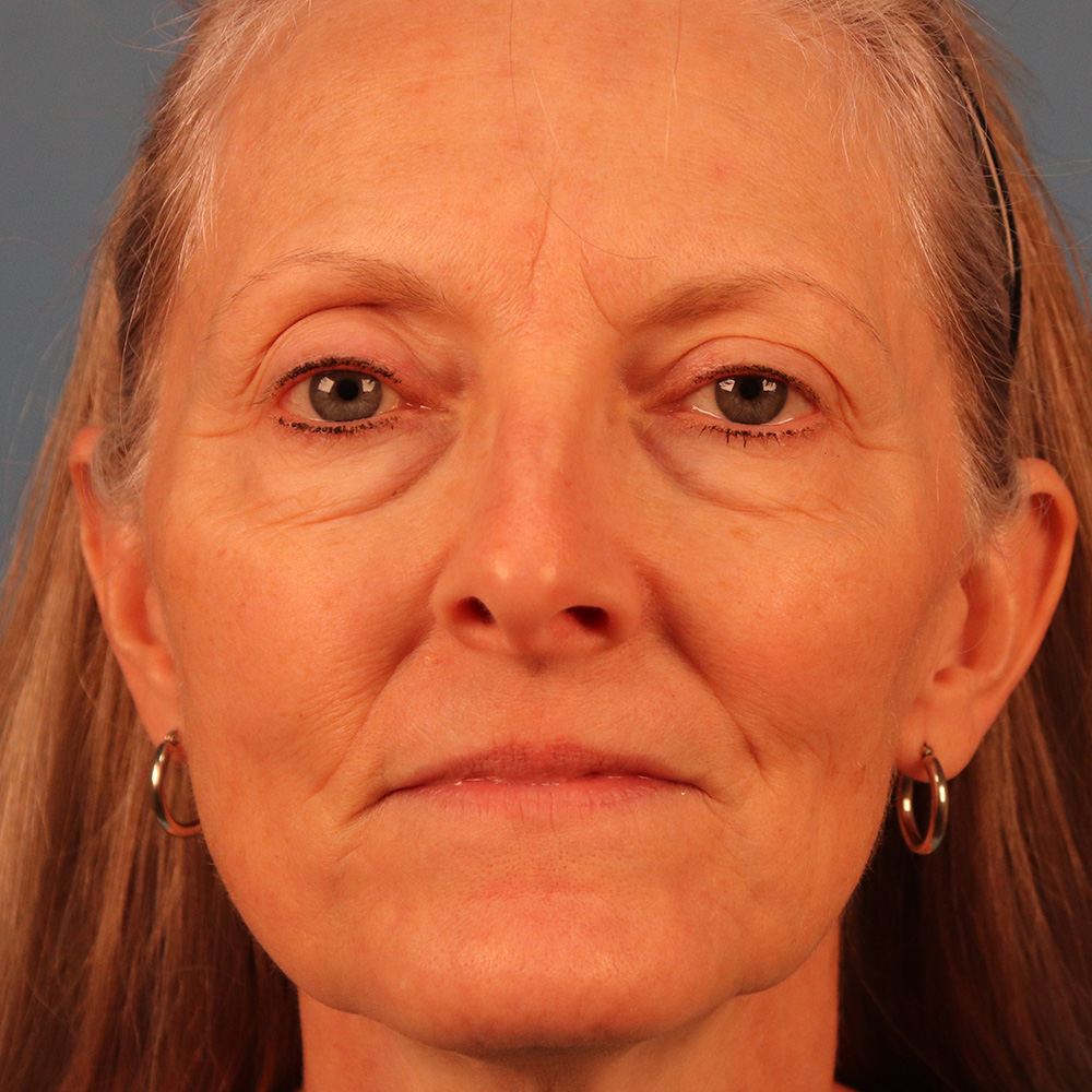 Case--1130 | Before Sciton Laser