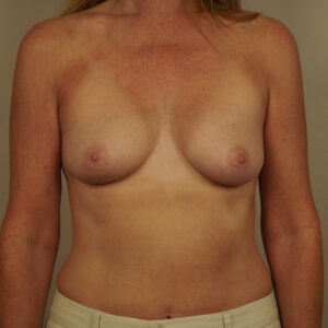 Case--9193 | Before Breast 1