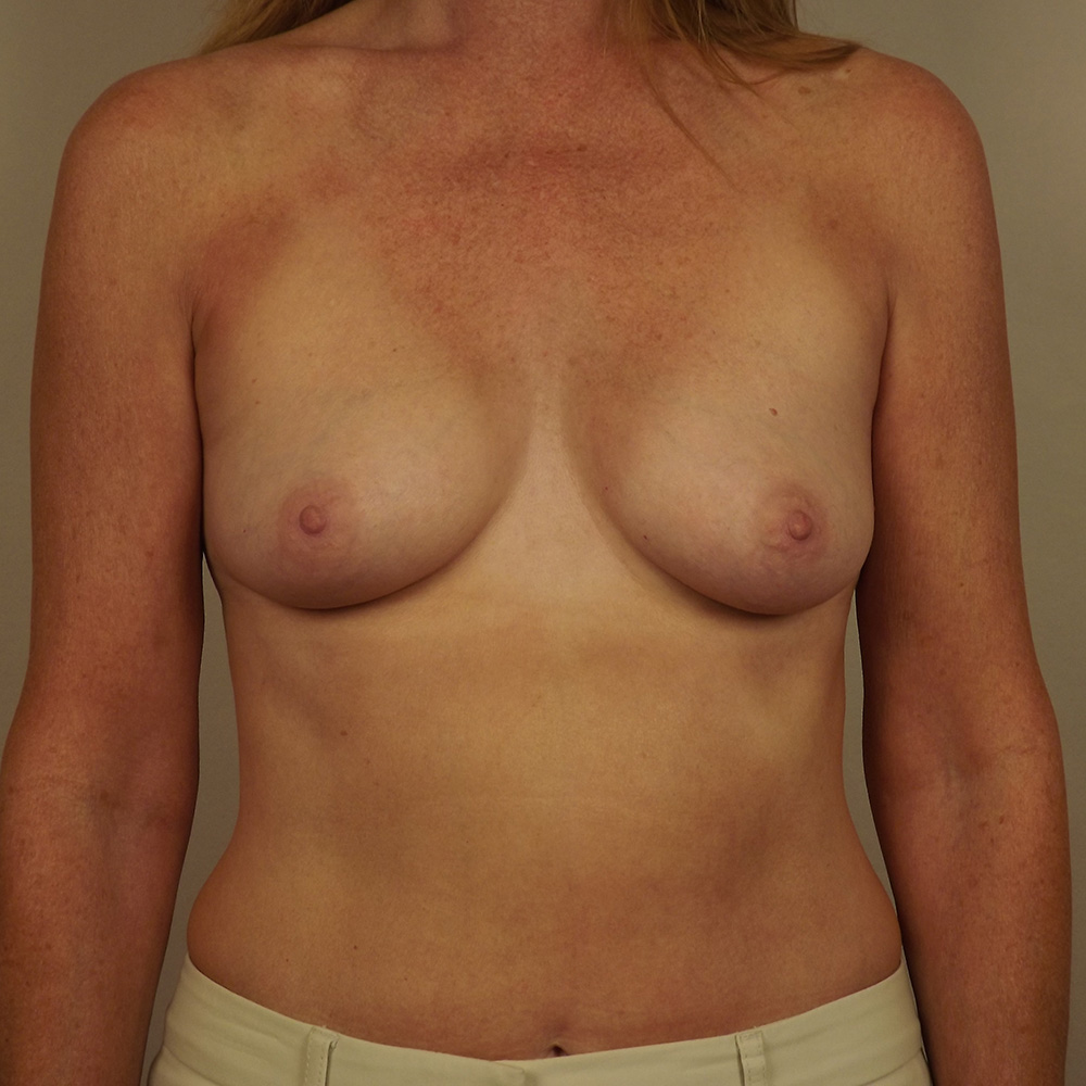 Case--9193 | Before Breast Augmentation