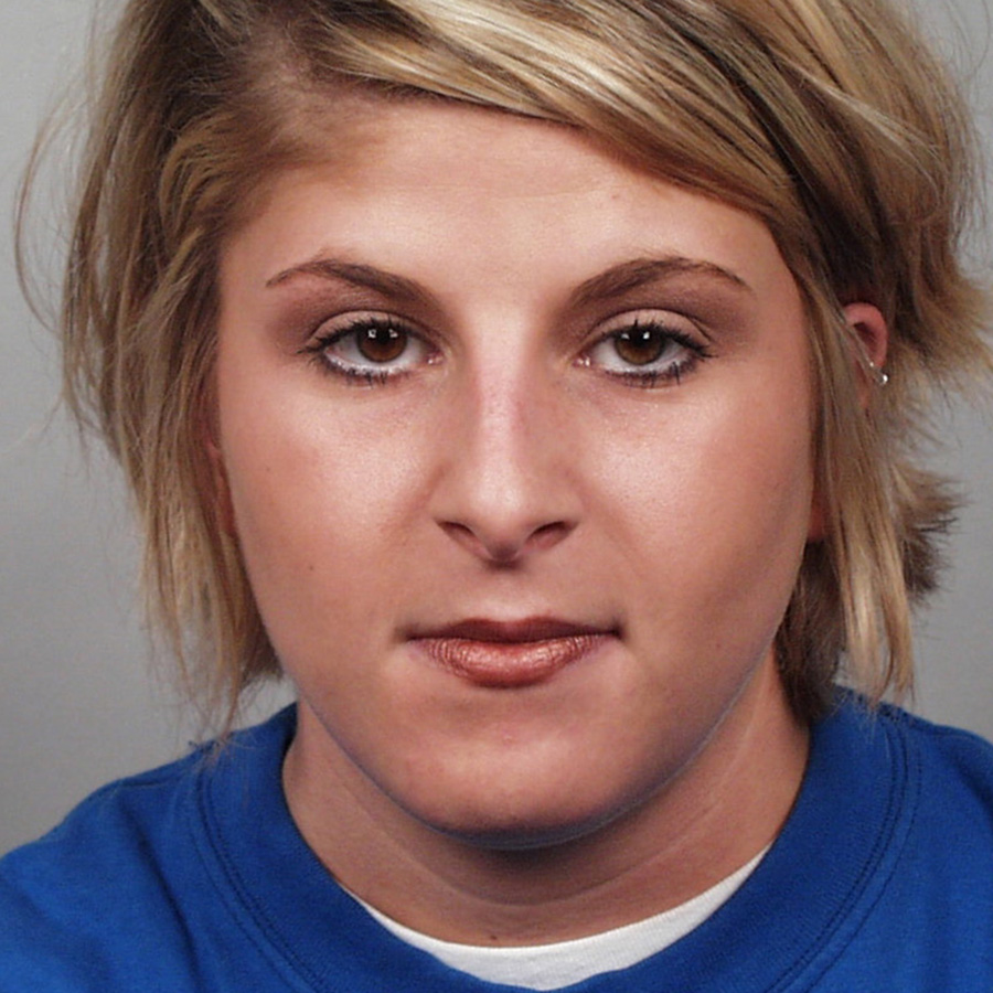 Case--7933 | Before Rhinoplasty