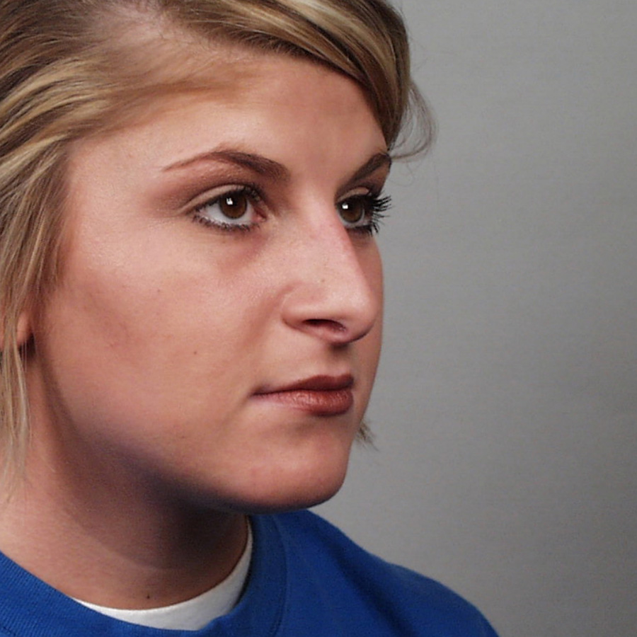 Case--7933 | Before Rhinoplasty 2