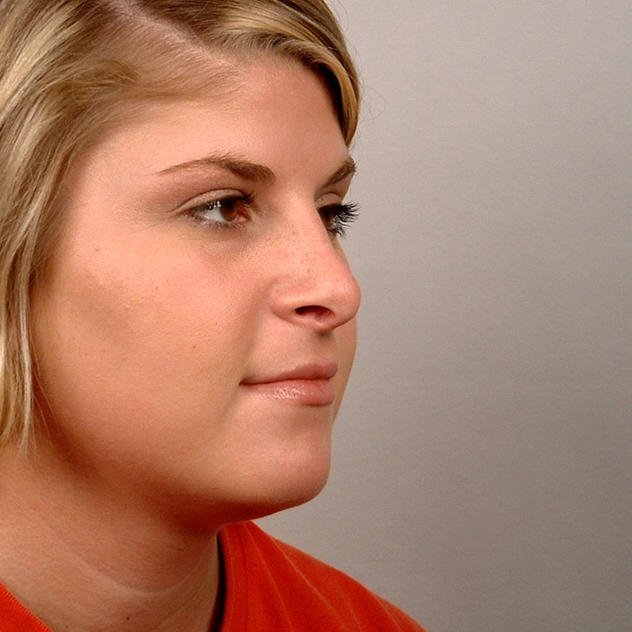 Case--7933 | After Rhinoplasty 2