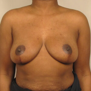 Case--2879 | After Bilateral Reduction Mammaplasty (Breast Reduction) 1