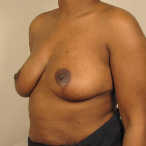Case--2879 | After Bilateral Reduction Mammaplasty (Breast Reduction) 2