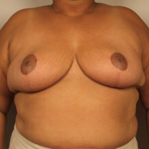 Case--1989 | After Bilateral Reduction Mammaplasty (Breast Reduction) 1
