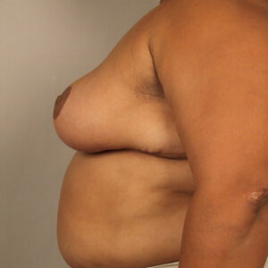 Case--1989 | After Bilateral Reduction Mammaplasty (Breast Reduction) 2