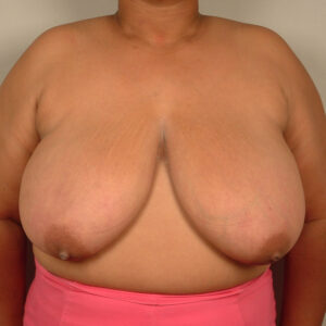 Case--1989 | Before Bilateral Reduction Mammaplasty (Breast Reduction) 1