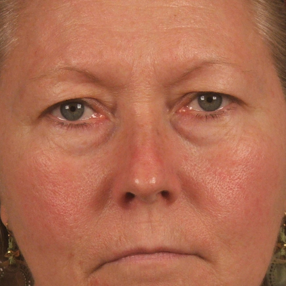 Case--4584 | Before Face