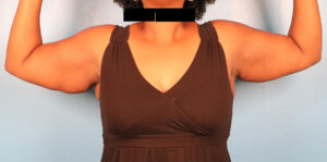 Case--5332 | Before Body 1