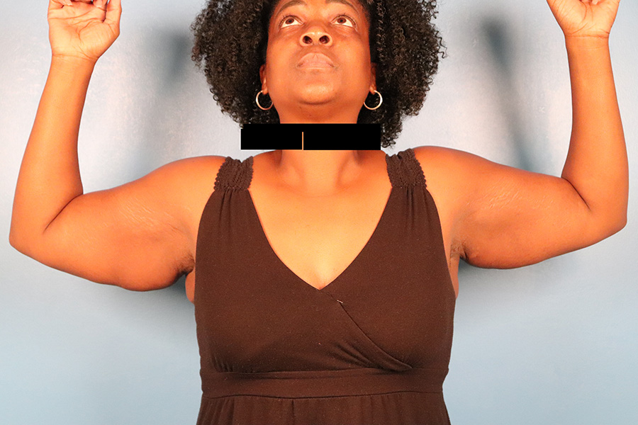 Case--5332 | Before Brachioplasty