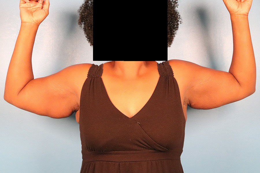 Case--5332 | Before Brachioplasty