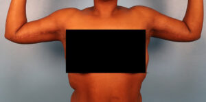 Case--5332 | After Body 1