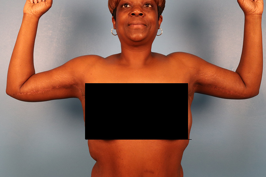 Case--5332 | After Brachioplasty