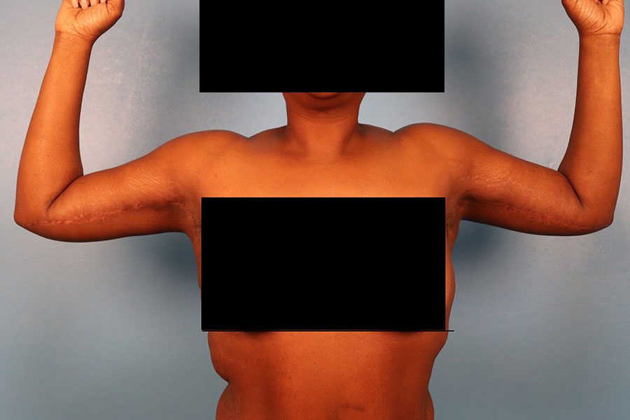 Case--5332 | After Brachioplasty