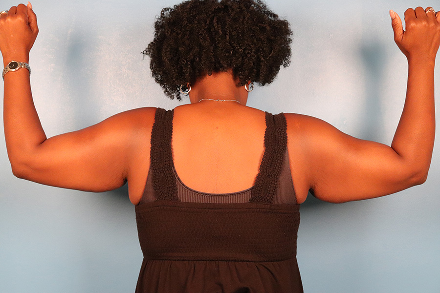 Case--5332 | Before Brachioplasty 2