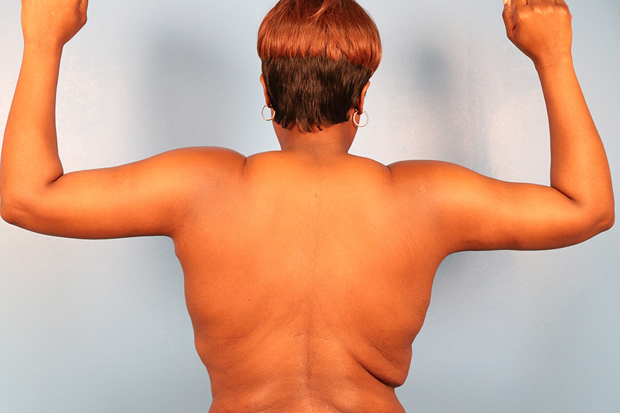 Case--5332 | After Brachioplasty 2