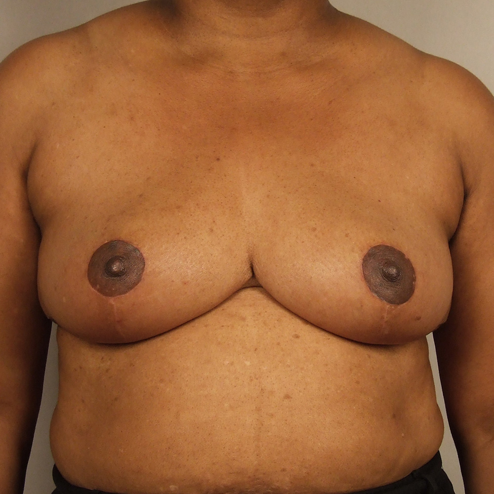 Case--6403 | After Bilateral Reduction Mammaplasty (Breast Reduction)