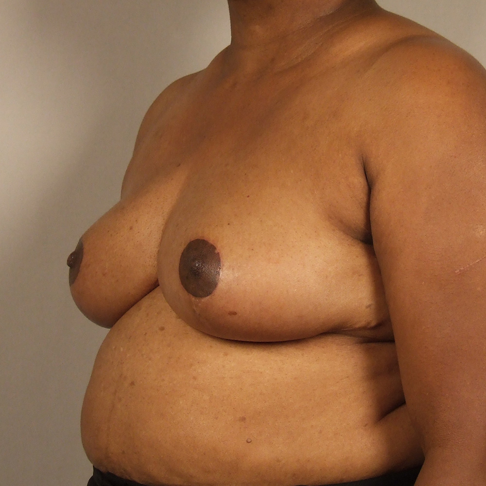 Case--6403 | After Bilateral Reduction Mammaplasty (Breast Reduction) 2
