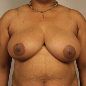 Case--6403 | Before Bilateral Reduction Mammaplasty (Breast Reduction) 1
