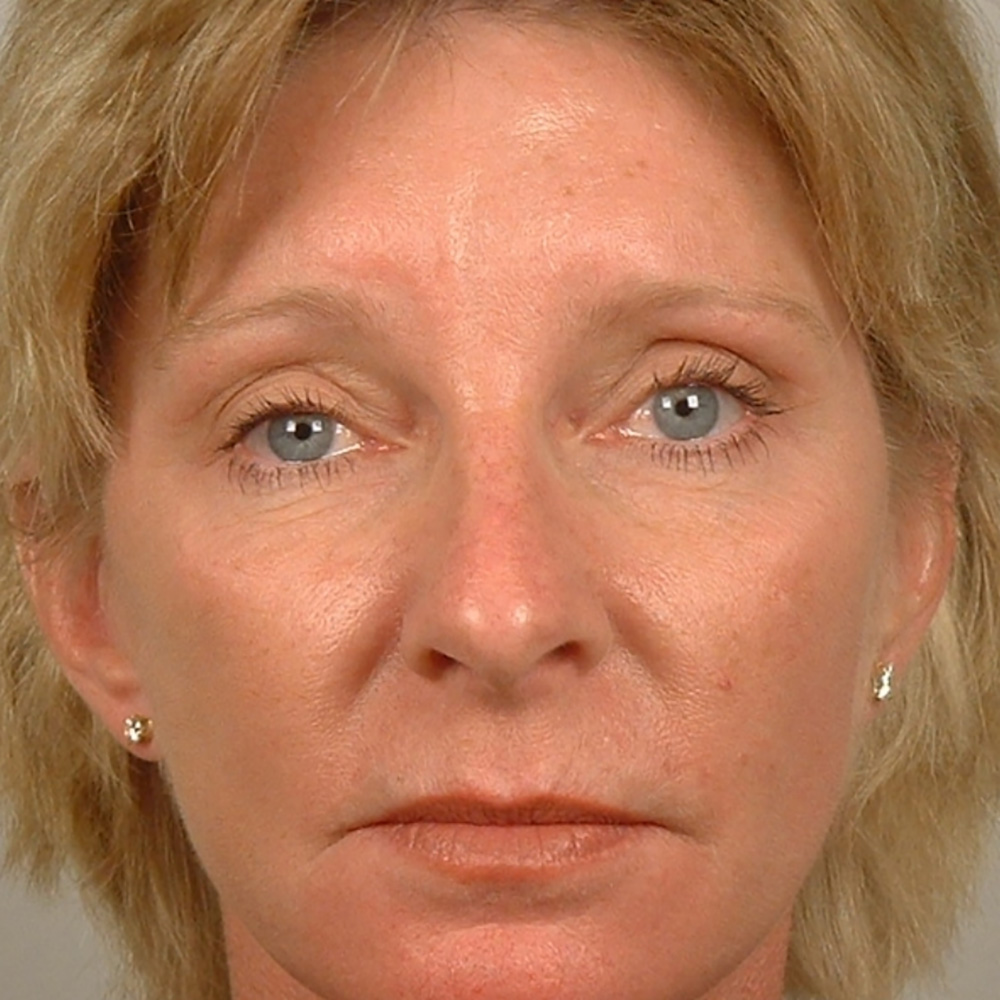 Case--8083 | After Face