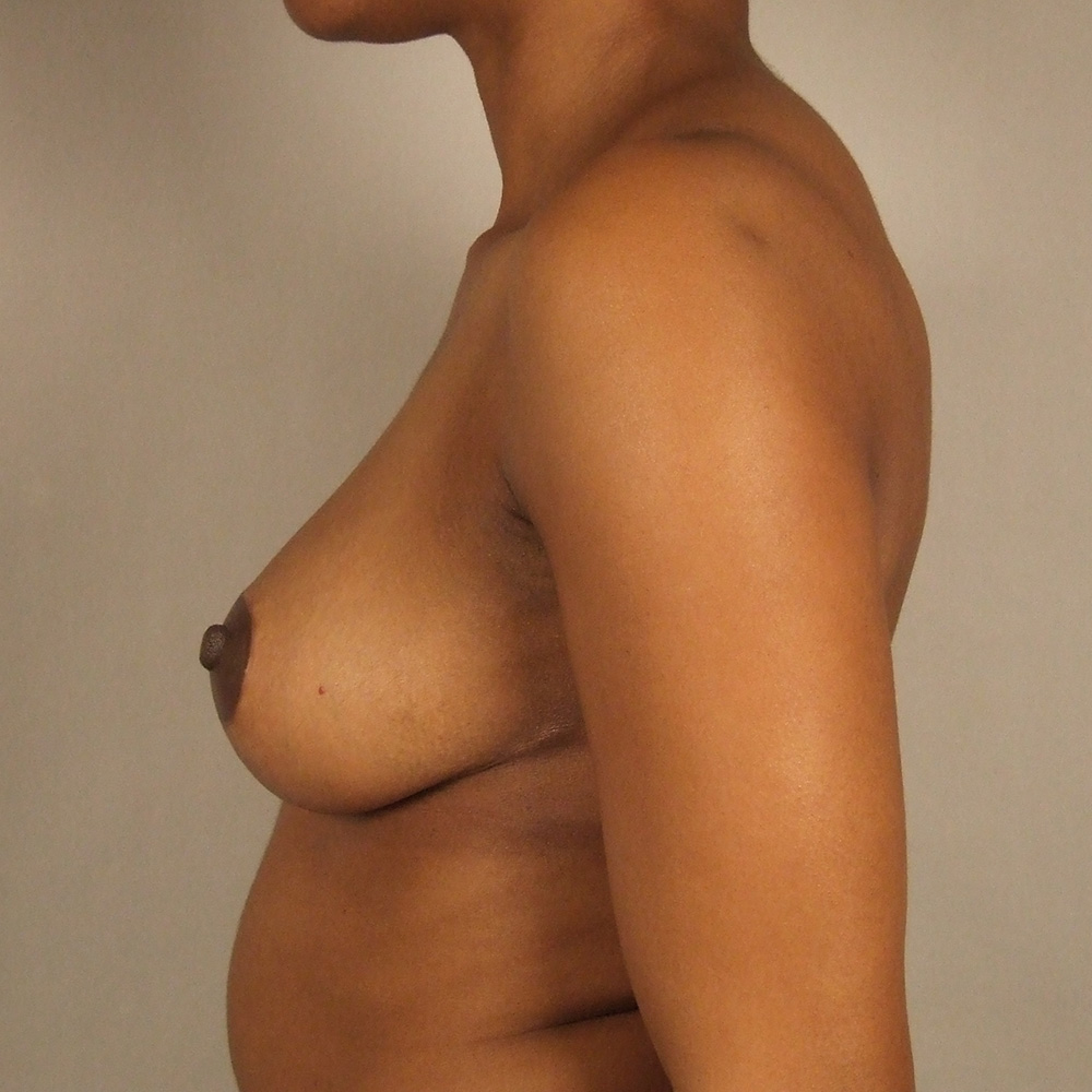 Case--1150 | After Bilateral Reduction Mammaplasty (Breast Reduction) 2