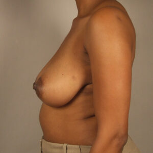 Case--1150 | Before Bilateral Reduction Mammaplasty (Breast Reduction) 2