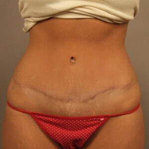 Case--1229 | After Abdominoplasty 1