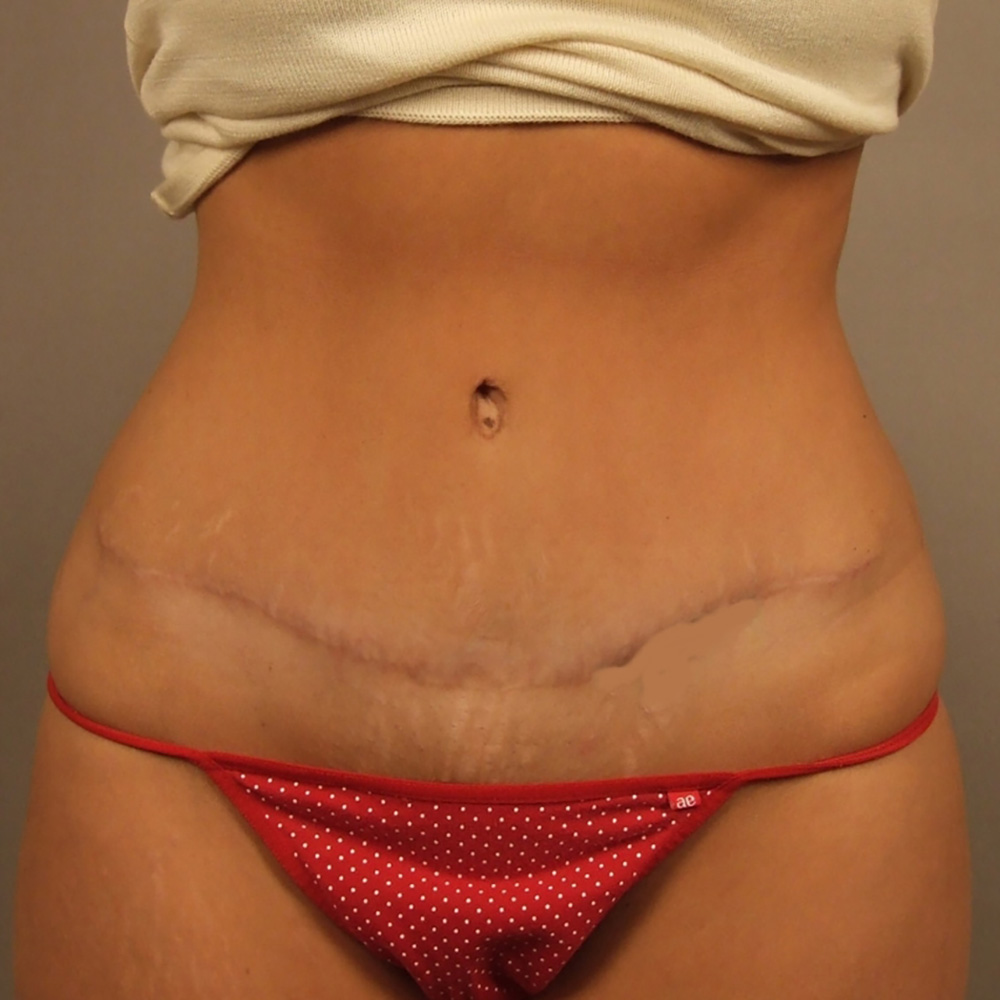 Case--1229 | After Body