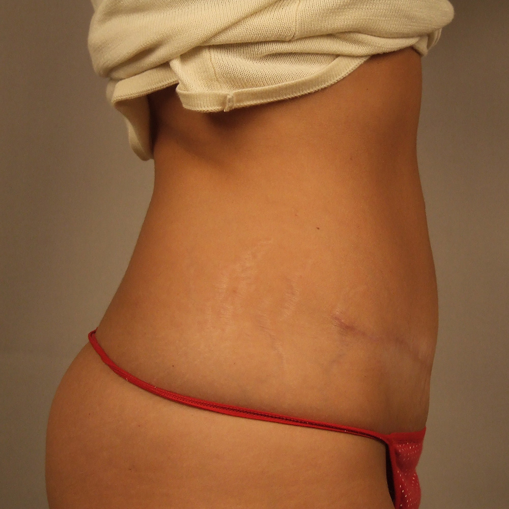 Case--1229 | After Abdominoplasty 2