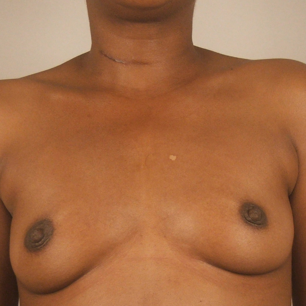 Case--5570 | Before Breast