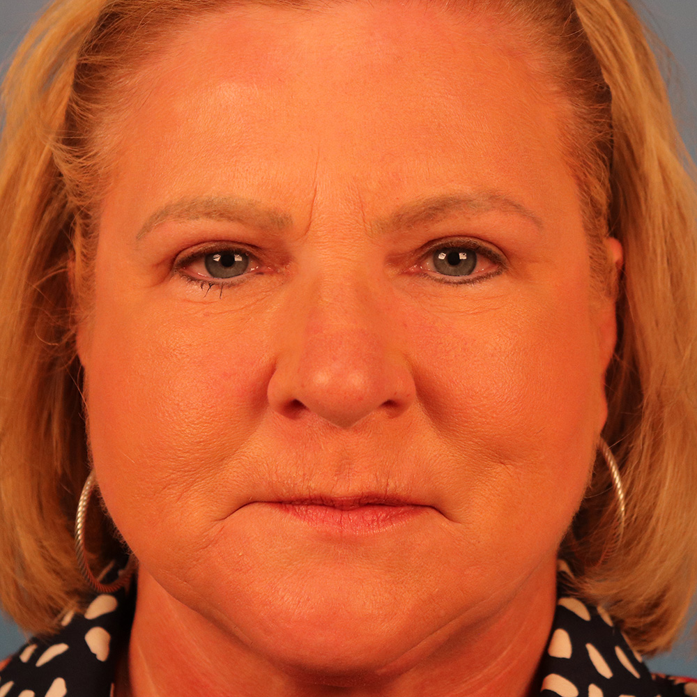 Case--9052 | After Blepharoplasty