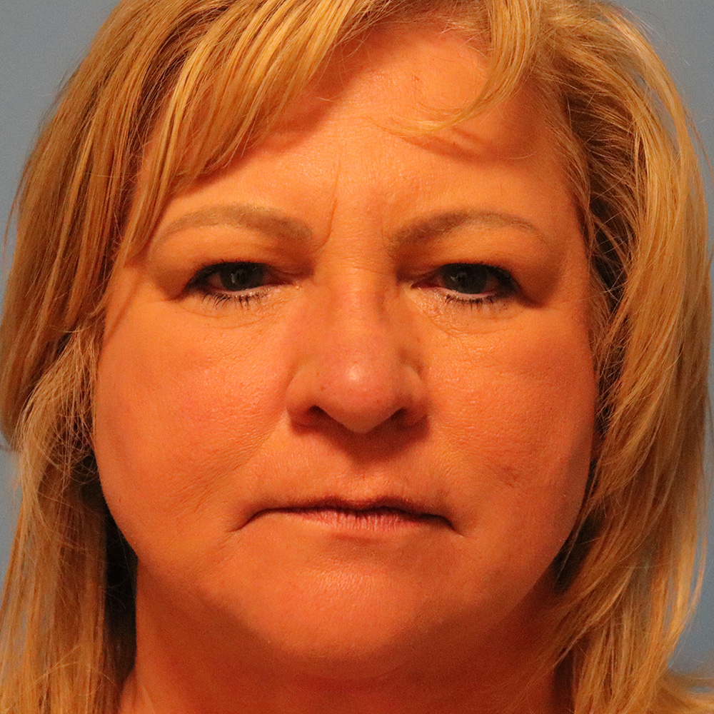 Case--9052 | Before Blepharoplasty