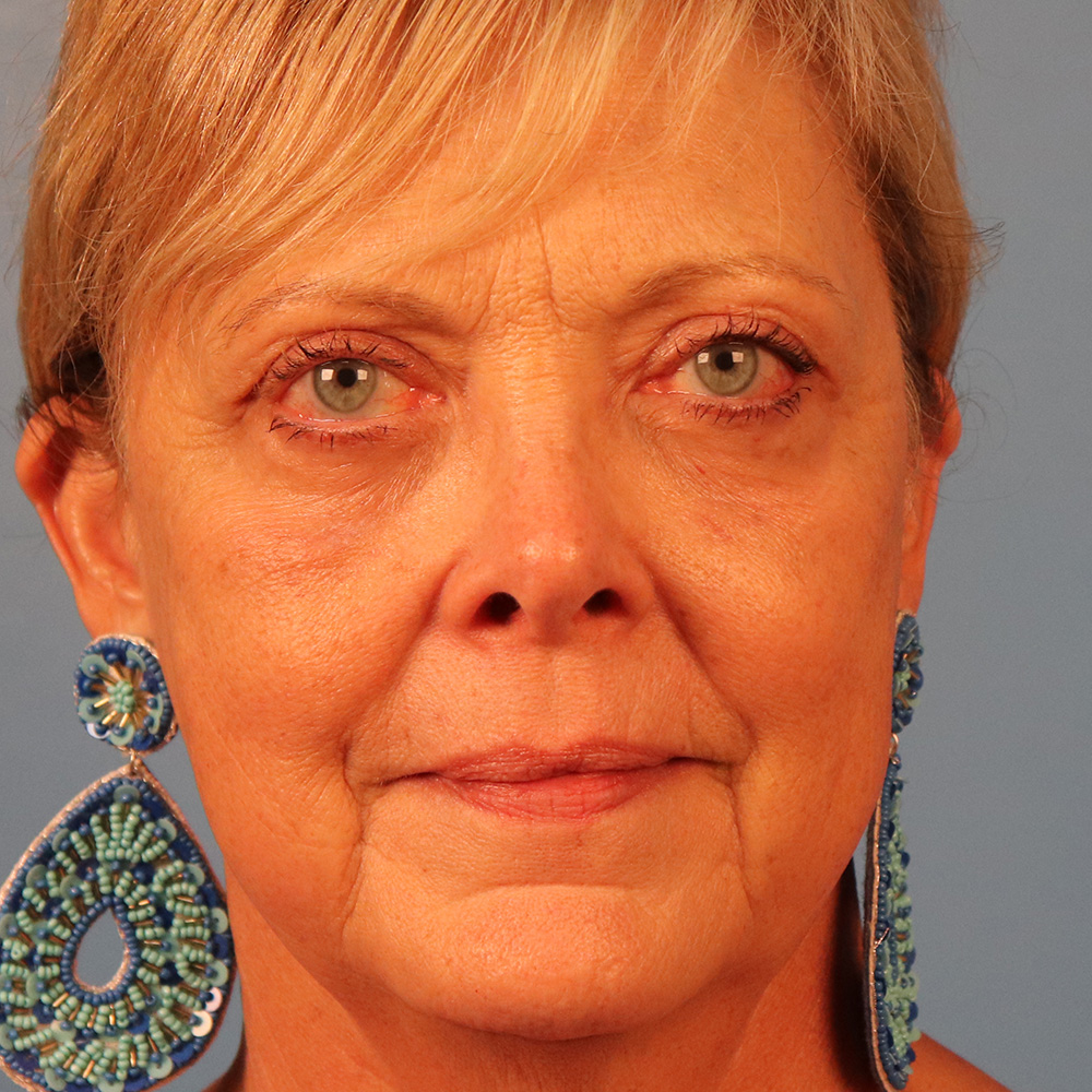 Case--5069 | After Blepharoplasty