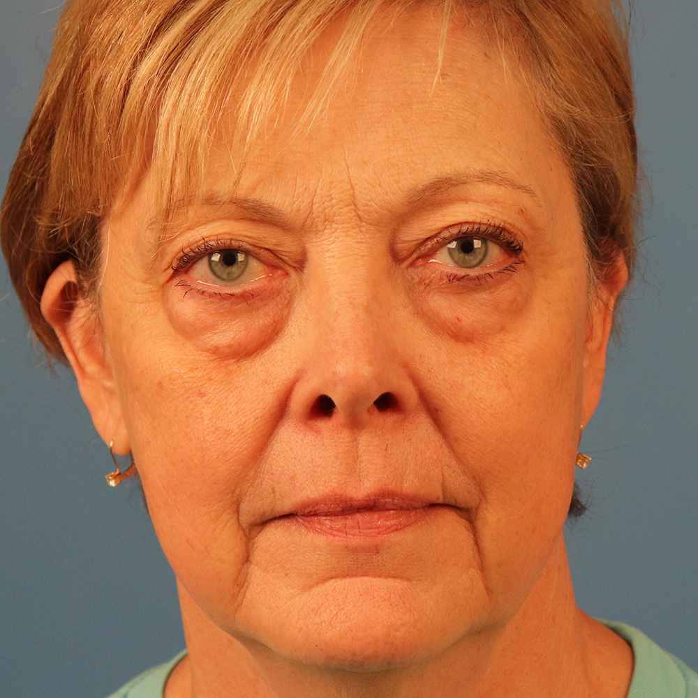 Case--5069 | Before Blepharoplasty