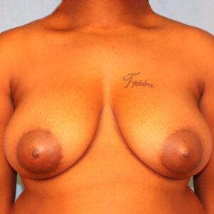 Case--1710 | Before Bilateral Reduction Mammaplasty (Breast Reduction) 1