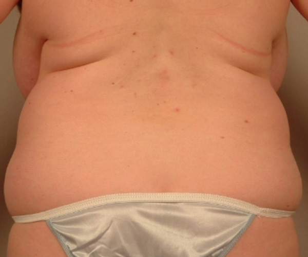 Case--4008 | Before Liposuction