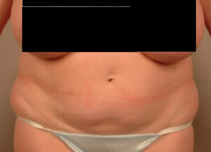 Case--3022 | Before Abdominoplasty 1