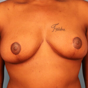 Case--1710 | After Bilateral Reduction Mammaplasty (Breast Reduction) 1