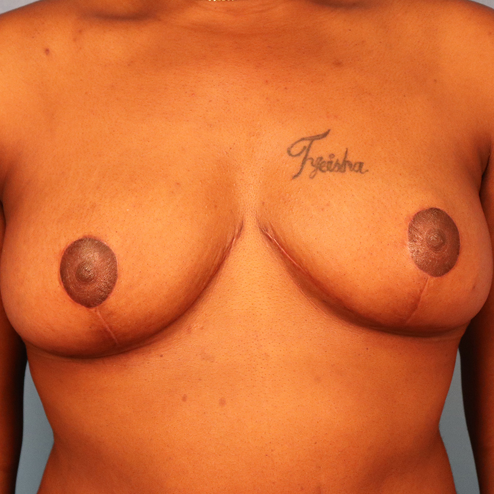 Case--1710 | After Breast