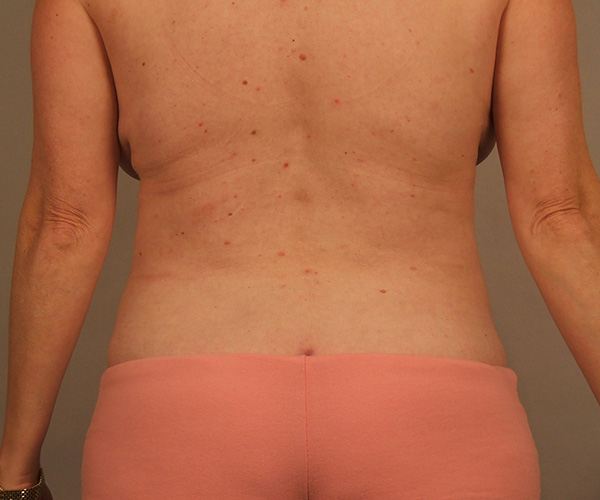 Case--4008 | After Liposuction