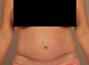 Case--3022 | After Abdominoplasty 1