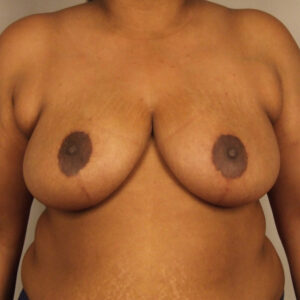 Case--2910 | After Bilateral Reduction Mammaplasty (Breast Reduction) 1
