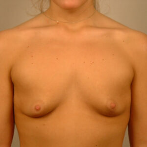 Case--4818 | Before Augmentation Periareolar Mastopexy 1
