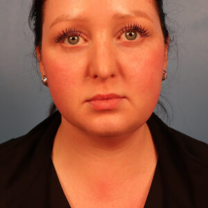 Case--1630 | Before Neck Lift 1