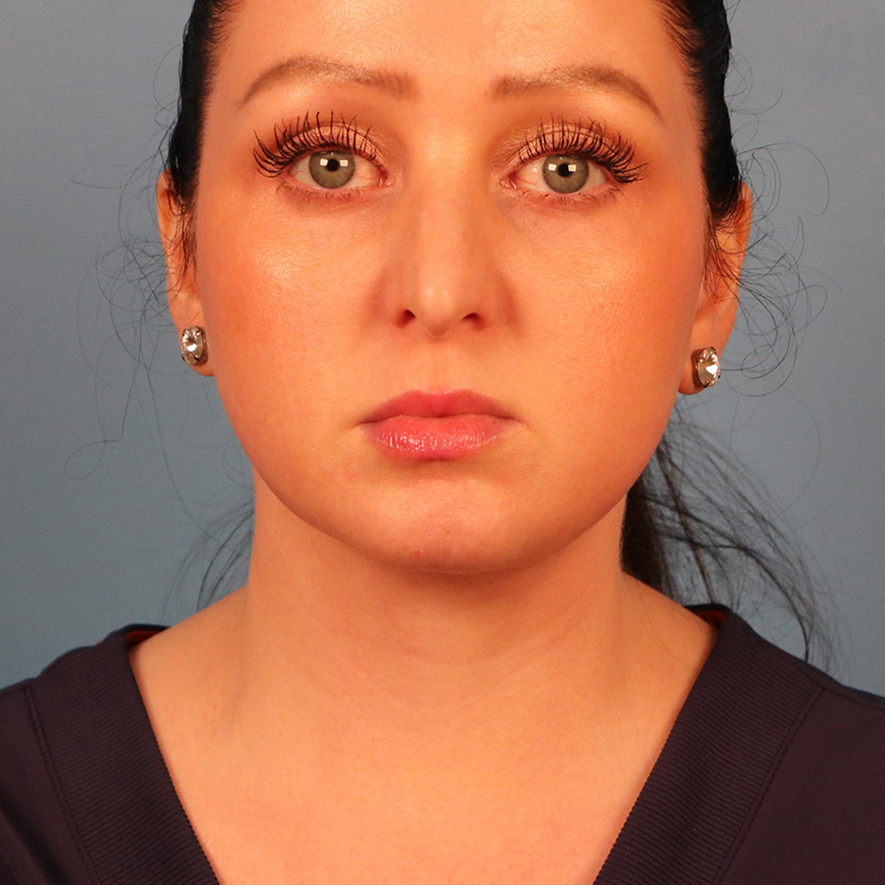 Case--1630 | After Neck Lift