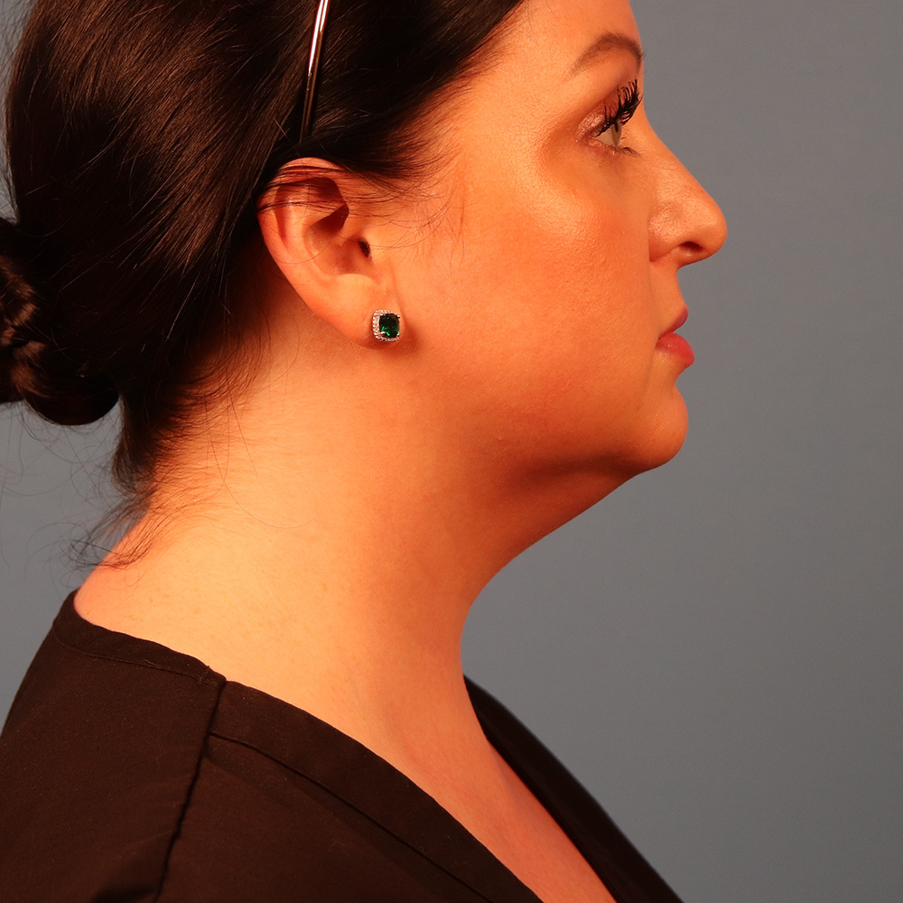 Case--1630 | Before Neck Lift 2