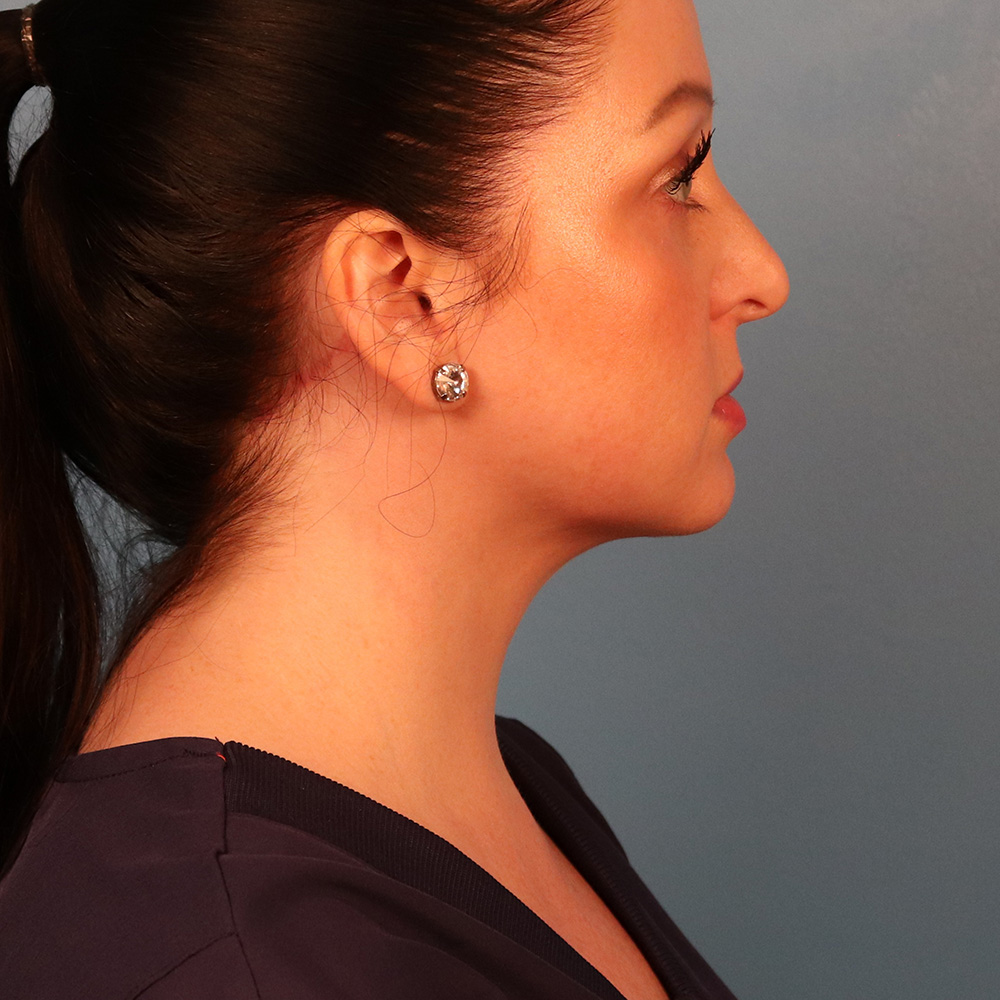 Case--1630 | After Neck Lift 2