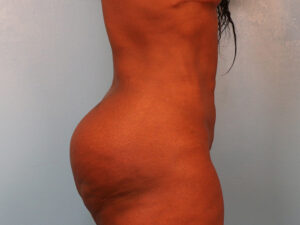 Case--30599 | Before Tummy Tuck (Abdominoplasty) 2